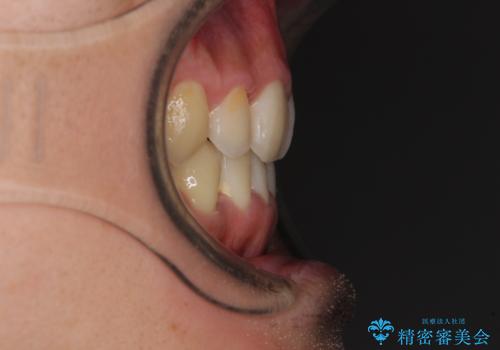 八重歯を治したい 目立たないワイヤー装置での抜歯矯正の治療後