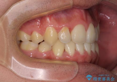八重歯を治したい 目立たないワイヤー装置での抜歯矯正の治療後