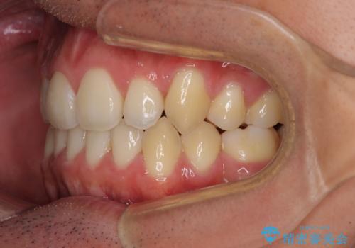 八重歯を治したい　目立たないワイヤー装置での抜歯矯正の治療後