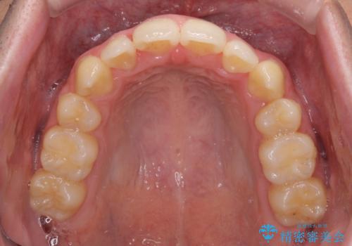八重歯を治したい 目立たないワイヤー装置での抜歯矯正の治療後