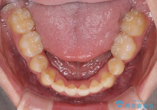 八重歯を治したい 目立たないワイヤー装置での抜歯矯正の治療後