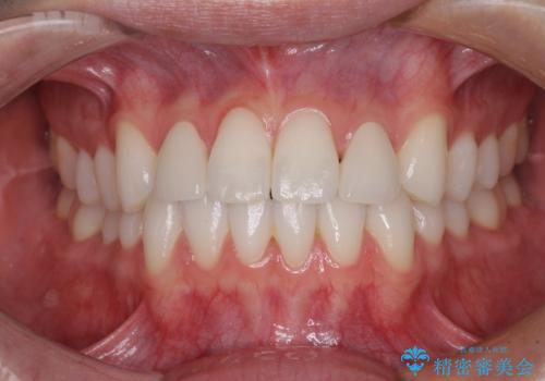 ラミネートの前歯をオールセラミッククラウンで自然にの治療後