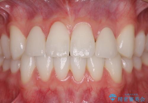ラミネートの前歯をオールセラミッククラウンで自然にの治療後