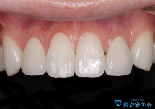 ラミネートの前歯をオールセラミッククラウンで自然にの治療後
