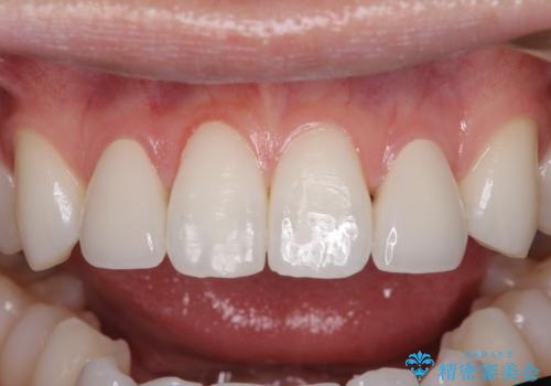 ラミネートの前歯をオールセラミッククラウンで自然にの治療後