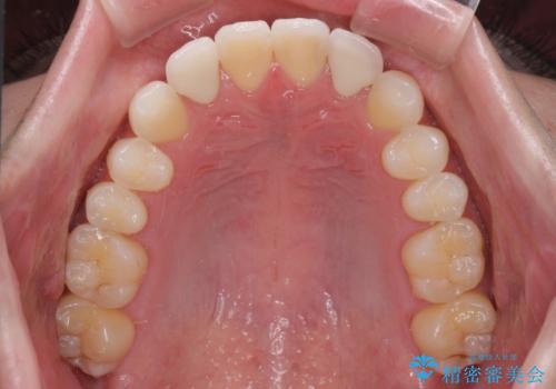 ラミネートの前歯をオールセラミッククラウンで自然にの治療後