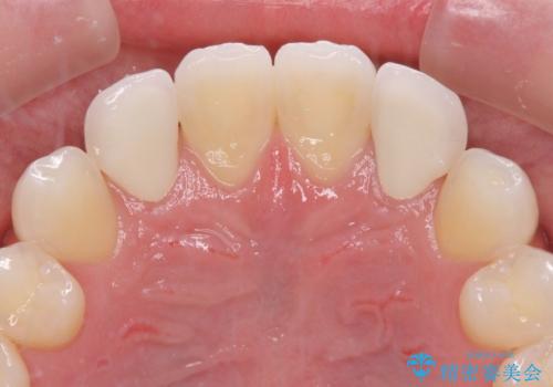 ラミネートの前歯をオールセラミッククラウンで自然にの治療後