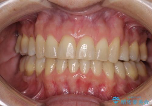 矯正の後戻りの改善と銀歯をセラミックにの症例 治療後