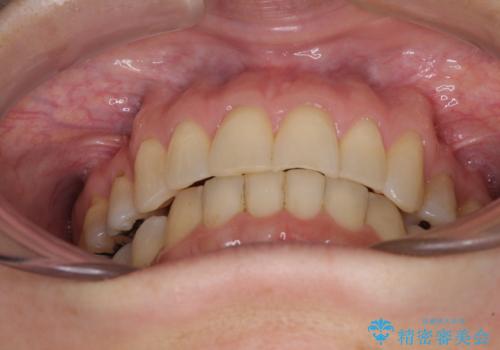 矯正の後戻りの改善と銀歯をセラミックにの治療後