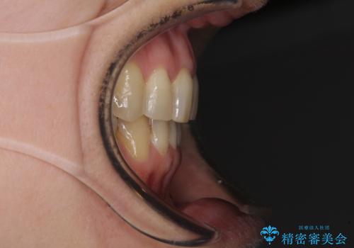 矯正の後戻りの改善と銀歯をセラミックにの治療後