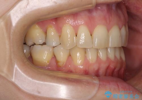矯正の後戻りの改善と銀歯をセラミックにの治療後