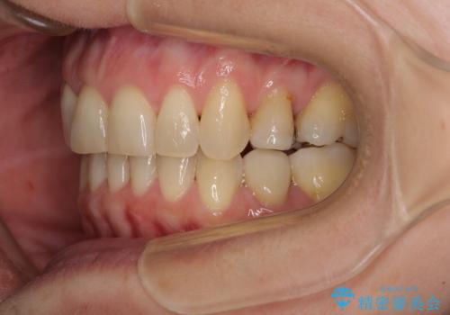 矯正の後戻りの改善と銀歯をセラミックにの治療後