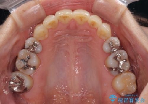 矯正の後戻りの改善と銀歯をセラミックにの治療後