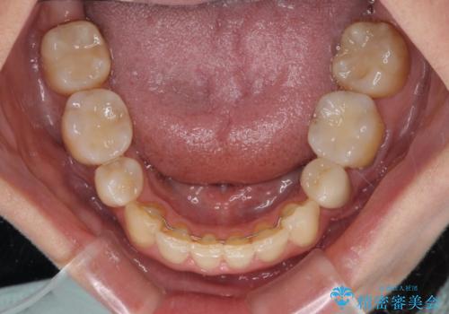矯正の後戻りの改善と銀歯をセラミックにの治療後