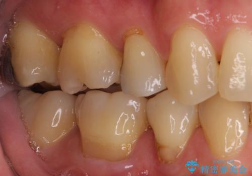 矯正の後戻りの改善と銀歯をセラミックにの治療後