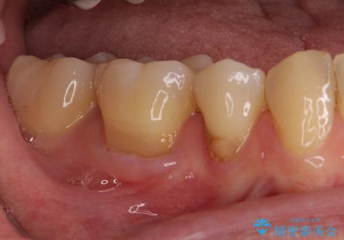 矯正の後戻りの改善と銀歯をセラミックにの治療後