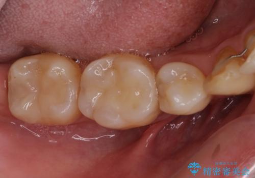 矯正の後戻りの改善と銀歯をセラミックにの治療後