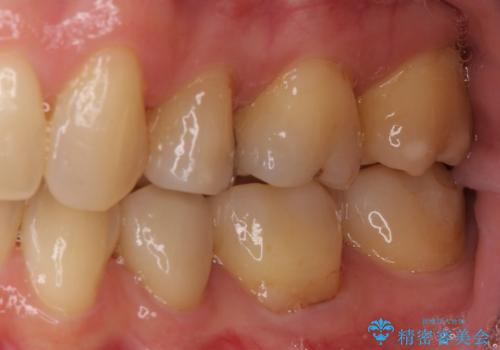 矯正の後戻りの改善と銀歯をセラミックにの治療後