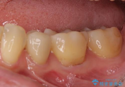 矯正の後戻りの改善と銀歯をセラミックにの治療後