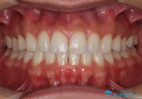 気になる後戻り 前歯をインビザライン・ライトで改善の症例 治療後