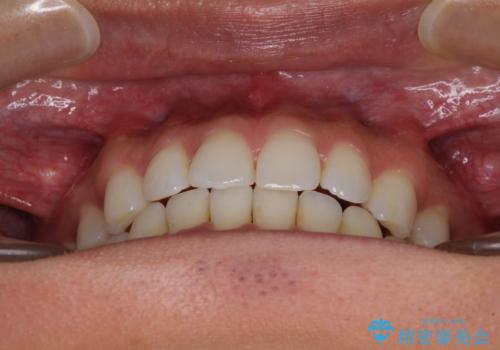 気になる後戻り 前歯をインビザライン・ライトで改善の治療後