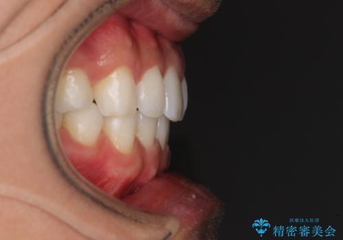 気になる後戻り 前歯をインビザライン・ライトで改善の治療後