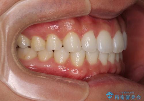 気になる後戻り 前歯をインビザライン・ライトで改善の治療後