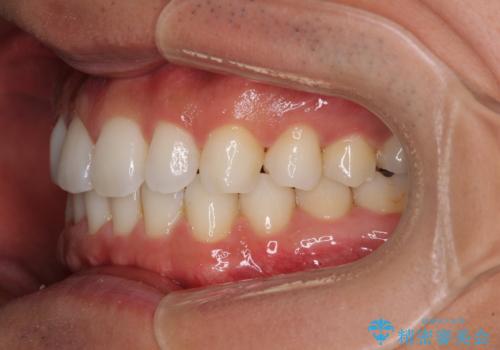 気になる後戻り 前歯をインビザライン・ライトで改善の治療後