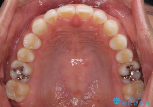 気になる後戻り 前歯をインビザライン・ライトで改善の治療後