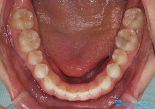 気になる後戻り 前歯をインビザライン・ライトで改善の治療後