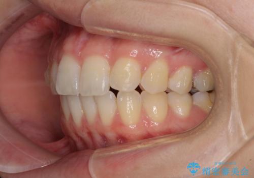 気になる上の歯を改善 インビザライン矯正の治療中