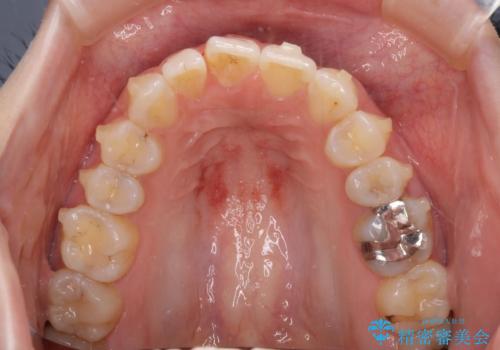 気になる上の歯を改善 インビザライン矯正の治療中