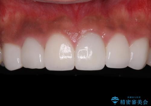 欠けてしまった前歯のセラミック　同じ色合いで再製作の症例 治療後