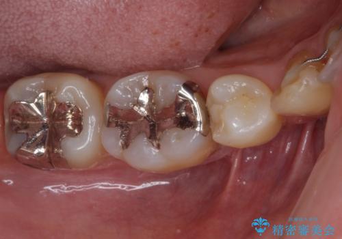 矯正の後戻りの改善と銀歯をセラミックにの治療前