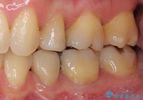 矯正の後戻りの改善と銀歯をセラミックにの治療前
