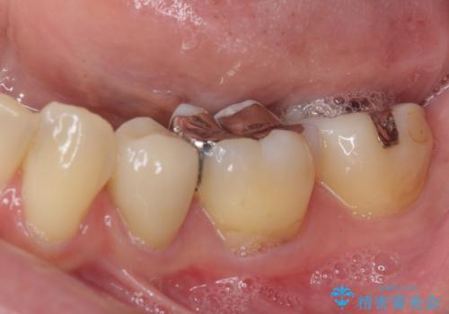 矯正の後戻りの改善と銀歯をセラミックにの治療前