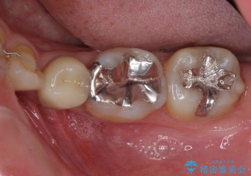 矯正の後戻りの改善と銀歯をセラミックにの治療前
