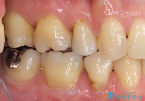 矯正の後戻りの改善と銀歯をセラミックにの治療前