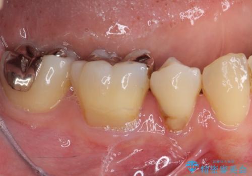 矯正の後戻りの改善と銀歯をセラミックにの治療前