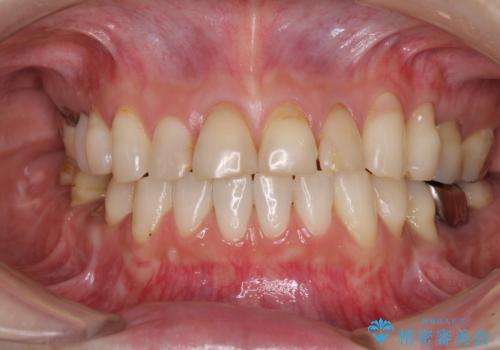 矯正しても虫歯が気になる　前歯のオールセラミッククラウンの治療前