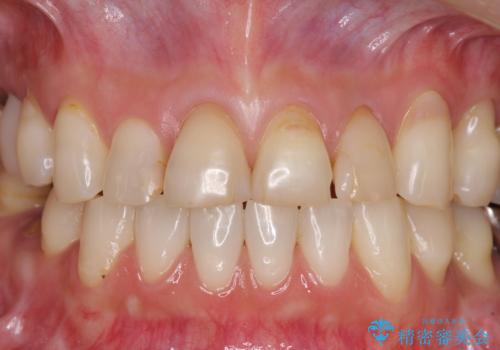 矯正しても虫歯が気になる 前歯のオールセラミッククラウンの治療前
