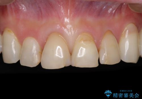 矯正しても虫歯が気になる 前歯のオールセラミッククラウンの治療前