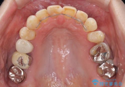 矯正しても虫歯が気になる 前歯のオールセラミッククラウンの治療前