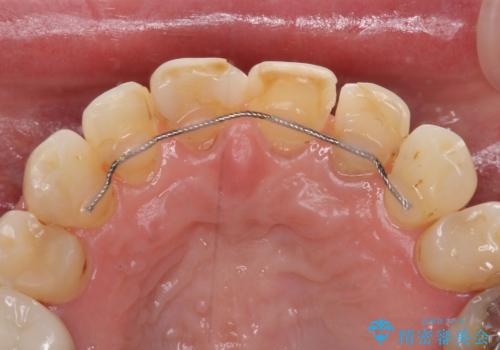 矯正しても虫歯が気になる 前歯のオールセラミッククラウンの治療前