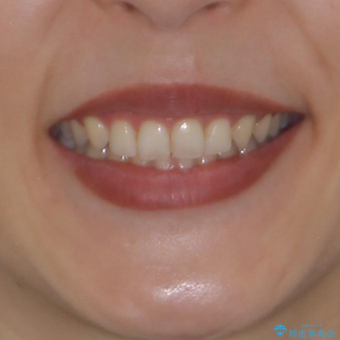 隙間だらけの歯列をきれいに　インビザライン矯正とセラミック補綴治療の治療後（顔貌）