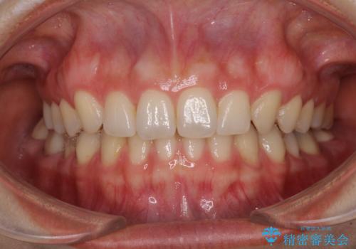 隙間だらけの歯列をきれいに インビザライン矯正とセラミック補綴治療の症例 治療後