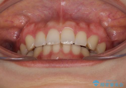 隙間だらけの歯列をきれいに インビザライン矯正とセラミック補綴治療の治療後