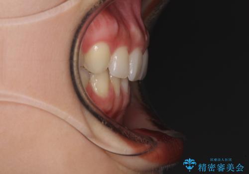 隙間だらけの歯列をきれいに インビザライン矯正とセラミック補綴治療の治療後