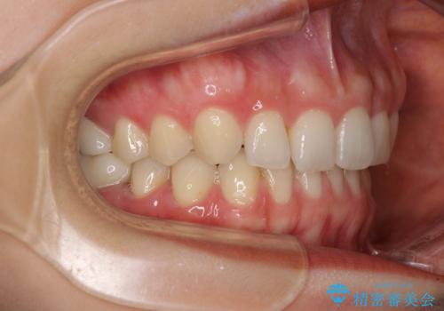 隙間だらけの歯列をきれいに インビザライン矯正とセラミック補綴治療の治療後