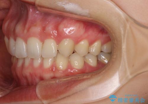 隙間だらけの歯列をきれいに インビザライン矯正とセラミック補綴治療の治療後